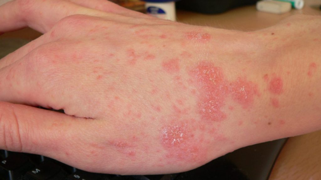Allarme Scabbia: casi già accertate in Italia | Sintomi e cure a disposizione