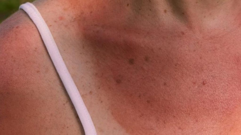 Come prevenire le scottature