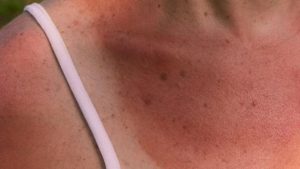 Come prevenire le scottature
