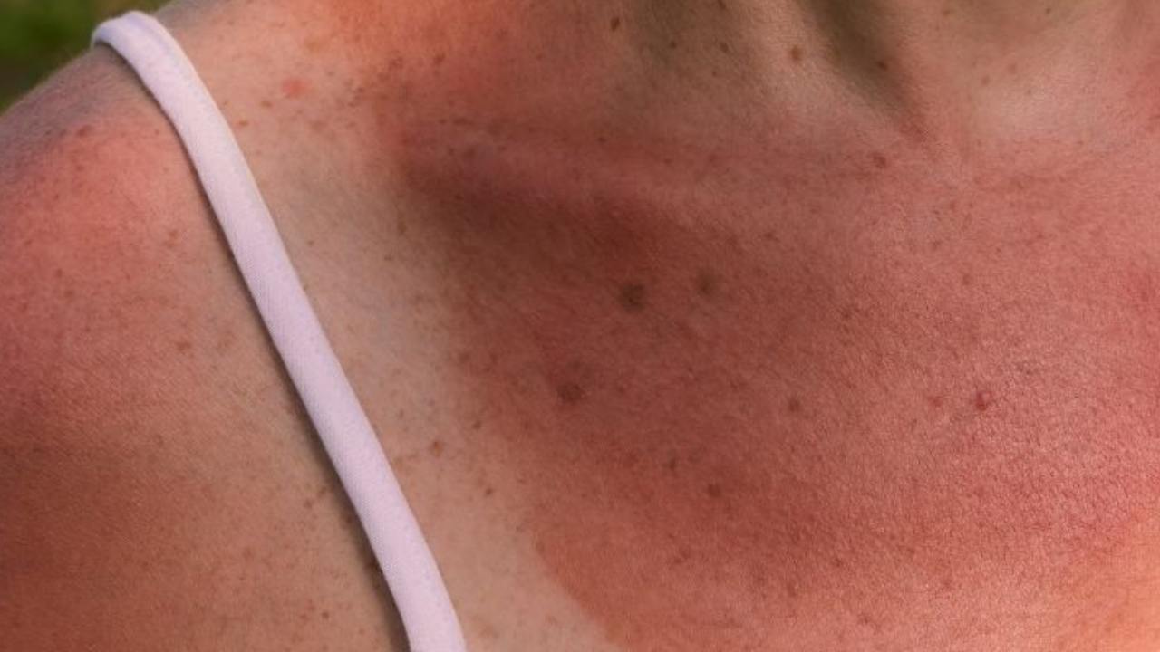 Scottature Solari: come rimediare immediatamente e trattare la pelle per evitare di rovinarla