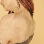 ragazza con scottature sulle spalle