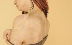 ragazza con scottature sulle spalle